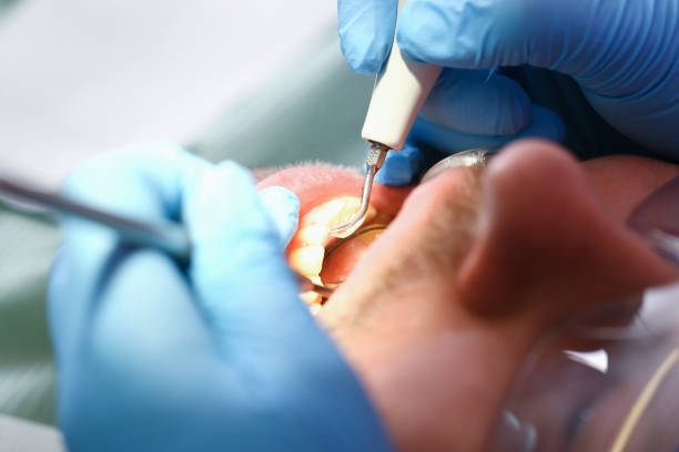 Best Emergency Root Canal Therapy in Lapeer, MI
