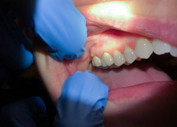 Best Knocked-Out Tooth (Avulsed Tooth) Treatment in Lapeer, MI