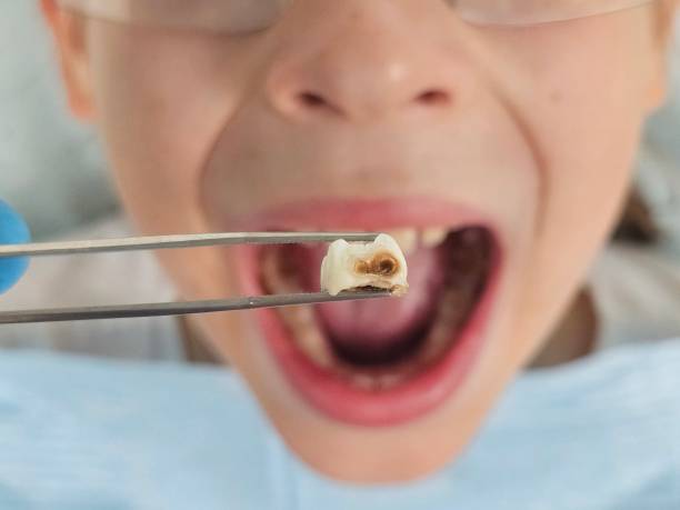 Best Emergency Treatment for Oral Infections in Lapeer, MI